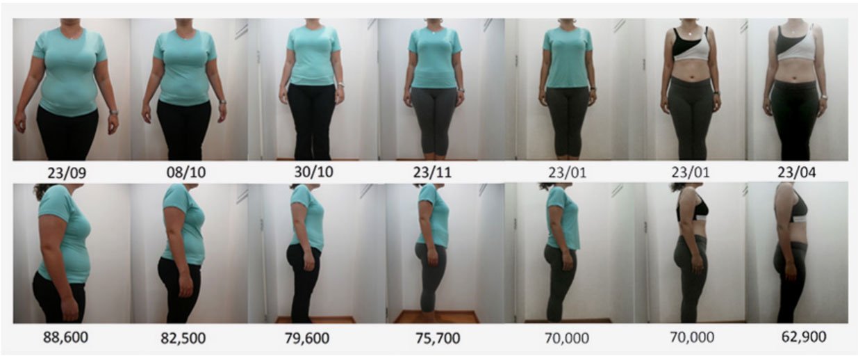 Balão Intragástrico - Métodos de emagrecimento minimamente invasivo